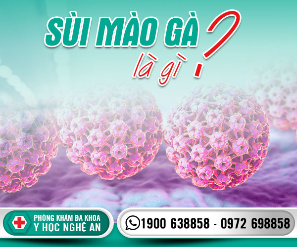 Sùi mào gà là gì