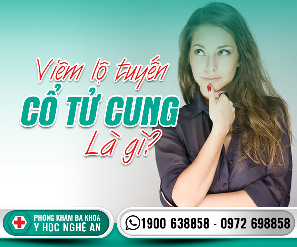 Viêm lộ tuyến cổ tử cung là gì