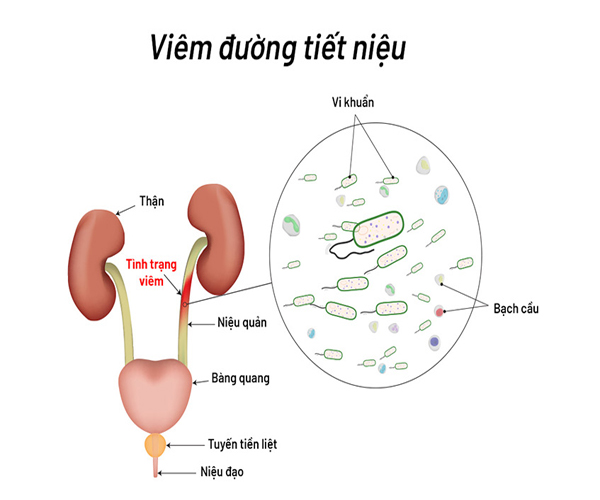 Viêm đường tiết niệu ở nam giới