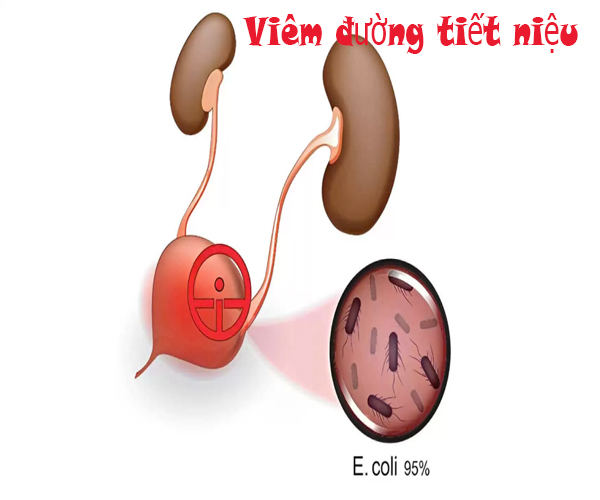 viêm đường tiết niệu